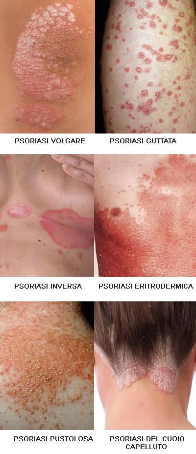 Sintomi Psoriasi