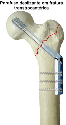 Cirurgia De Femur Com Placa E Parafuso - Fratura do Quadril - Fratura do colo femoral - Cirurgia - Fratura ...