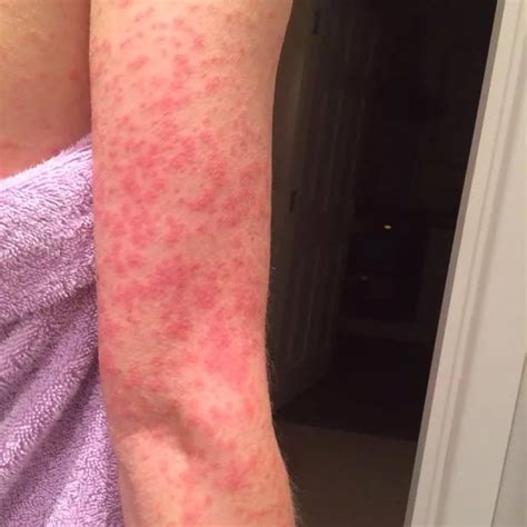 Images Show Eight Types Of Rash That Could Be Symptom Of Coronavirus