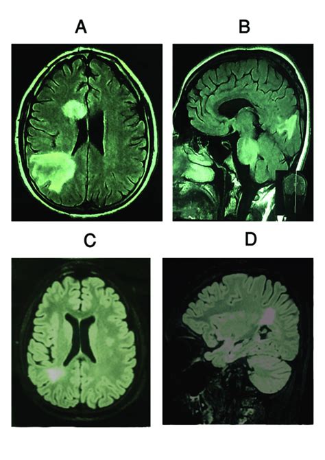 A B C Mri Revealed Demyelinating Plaques In The Pons And Temporal Download Scientific