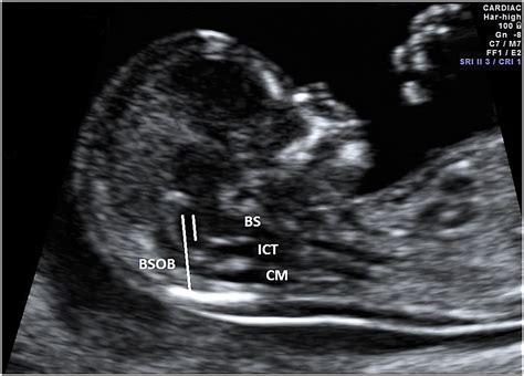 Spina Bifida Signs