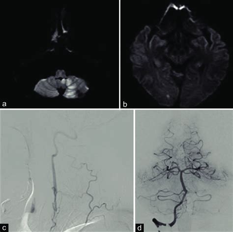 A And B Magnetic Resonance Images Showing Left Cerebellar Infarction Download Scientific