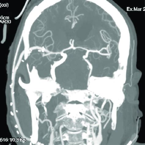 Postoperative Three Dimensional Reconstructed Ct Angiography Of The