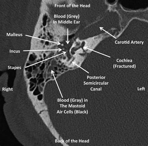 Axial (horizontal) CT of the right temporal bone 1 mm above figure 2 ...