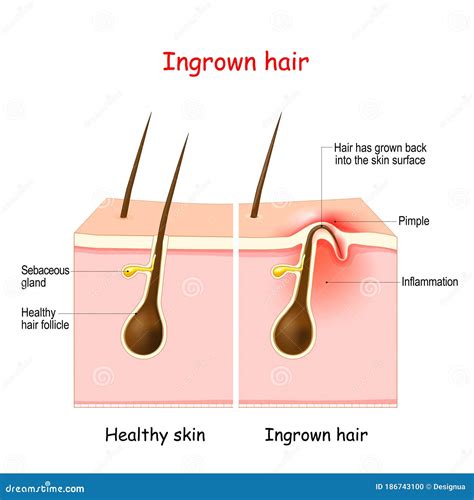 Ingrown Hair Structure Cartoon Vector | CartoonDealer.com #124482393