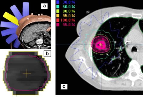 Quantification Of Incidental Dose To Potential Clinical Target Volume