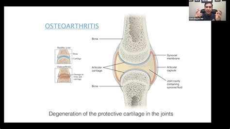 Viscosupplementation For Knee Osteoarthritis YouTube