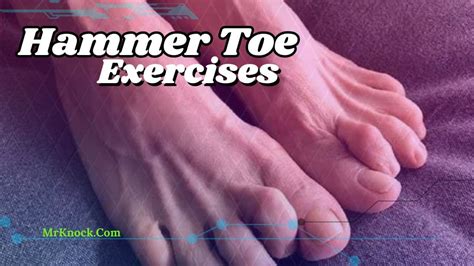 Best Hammer Toe Exercises: Understanding and Addressing