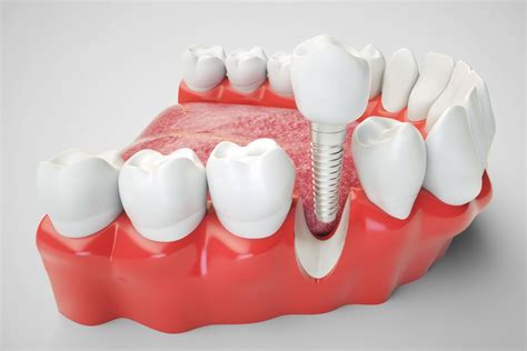 The Ultimate Guide To Dental Implants Ekiz Dental Clinic