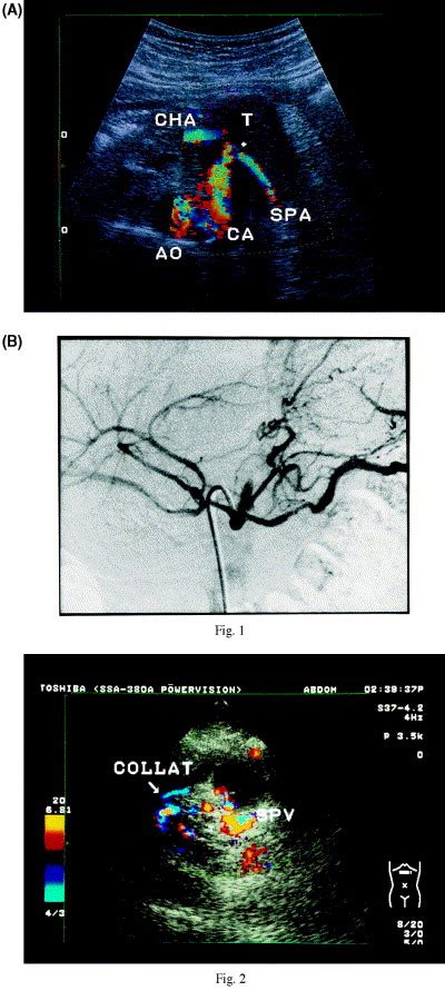 Pancreas Imaging Diagnosis With Colorpower Doppler Ultrasonography