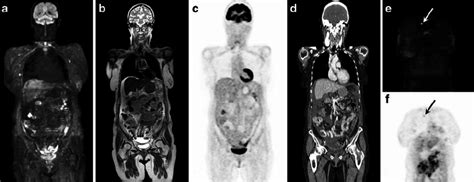 A B Whole Body Dwimri Depicts Multifocal B1000 Hyperin