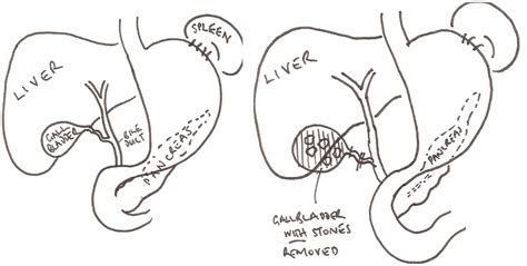 Laparoscopic Cholecystectomy Removal Of The Gall Bladder Using Keyhole Surgery Hull