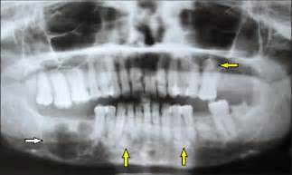 Orthopantamogram Showing Multilocular Radiolucency On The Right Body Of