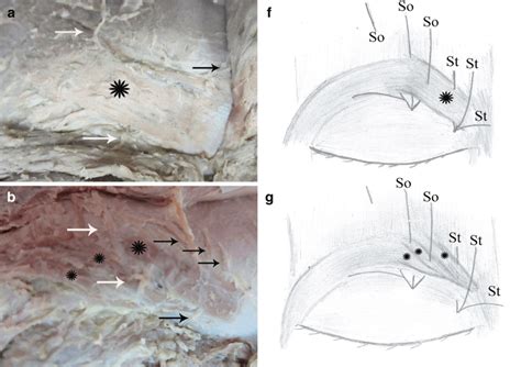 of the Supraorbital Region | Plastic Surgery Key