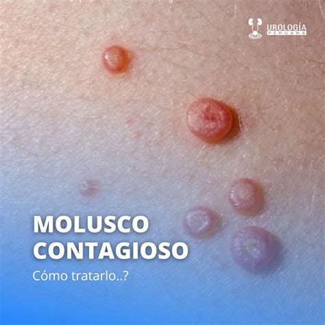 Tratamiento del molusco contagioso Urología Peruana Dr Susaníbar