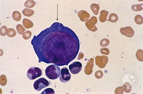 Pure Red Cell Aplasia Ask Hematologist Understand Hematology