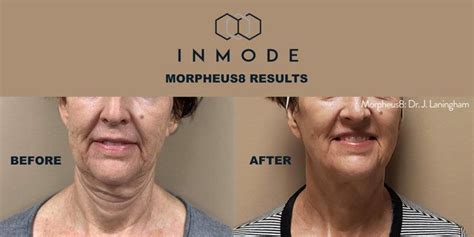 Tighten And Tone Your Skin With Morpheus8 Sandy Key Medical