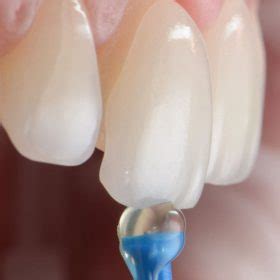 Tipos de Carillas Dentales Ventajas y Desventajas Clínica dental