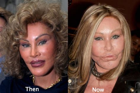 Jocelyn Wildenstein Prima E Dopo