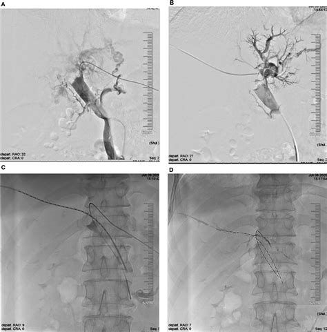 Frontiers Endovascular Brachytherapy With Iodine 125 Seed Strand For