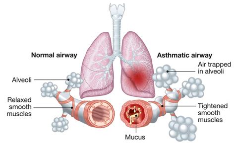 1,514 Asthma Diagram Images, Stock Photos, 3D objects, & Vectors ...