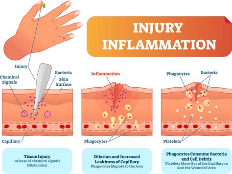 Repasamos Inflamación Tipos Y Patologías Asociadas Misistemainmune