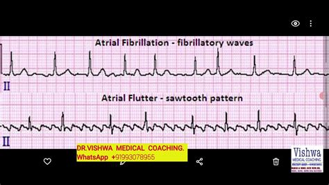 Difference Between ATRIAL FLUTTER ATRIAL FIBRILLATION Quick Video 90