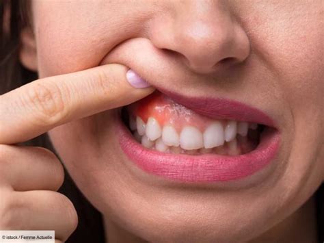 Parodontite les différents traitements contre le déchaussement des dents