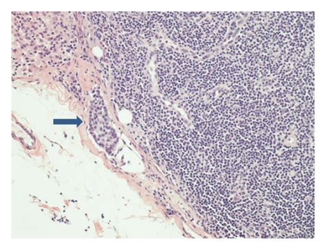 Invasive Ductal Carcinoma Idc Moderately Differentiated A X100