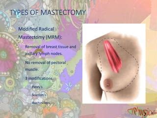 Mastectomy | PPT