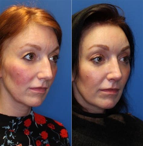 Nose Surgery Before And After Photos Patient 252 San Francisco Ca Kaiser Permanente Cosmetic