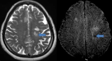 Multiple Slerosis Axial T2w And Swi Images The Demyelinating Download Scientific Diagram