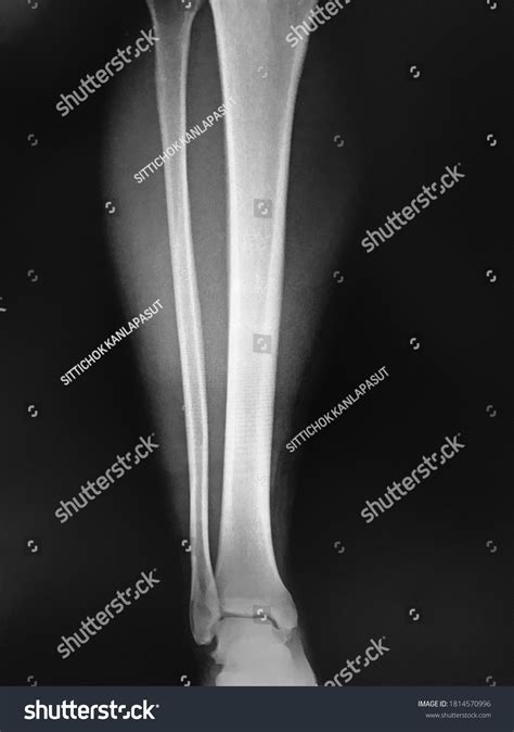 Xray Normal Human Tibia Lateral View Stock Photo 1814570996 Shutterstock