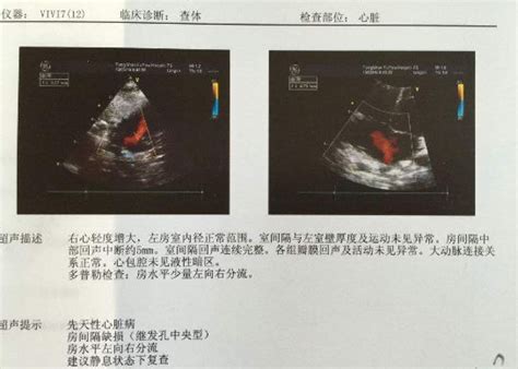 心脏彩超和四维彩超有什么区别