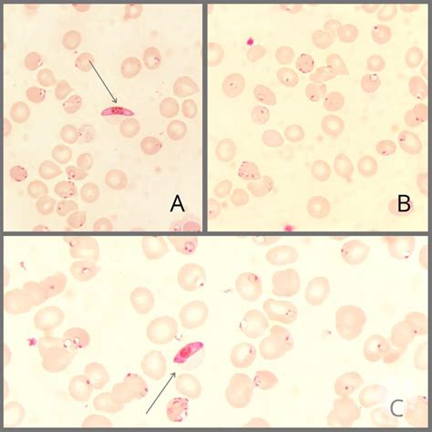 Plasmodium Falciparum And Babesia Importance Of Thin Film Examination For Morphological