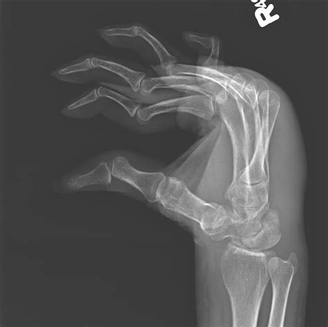 Wrist Xray Lines At James Mack Blog