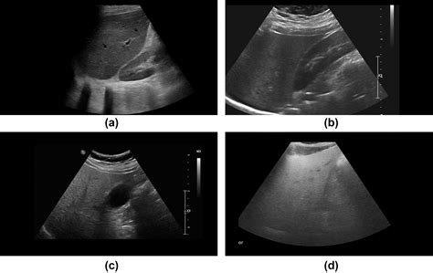 Ultrasound Based Hepatic Fat Quantification Current Status And Future