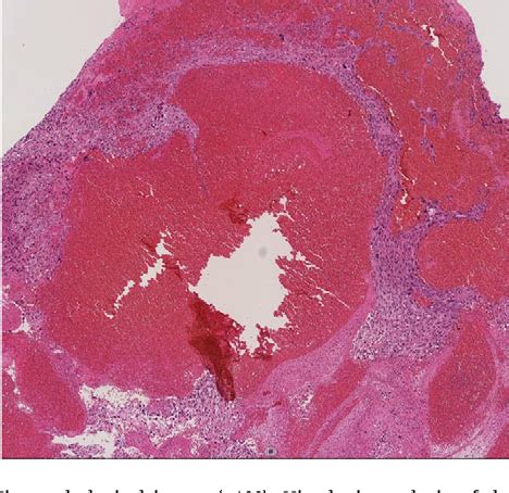 Figure 3 From A Case Of Pulmonary Artery Sarcoma That Was Initially Mis