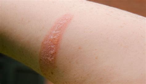 2nd Degree Burn What It Looks Like Treatment And Healing