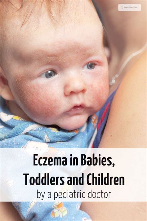 Eczema in Babies, Toddlers and Children Snotty Noses