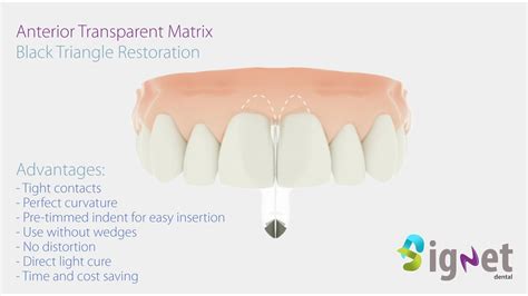 Black Triangle Restoration With Signet Transparent Anterior Matrix