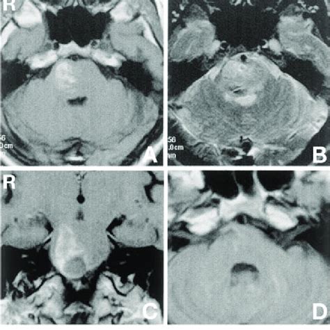 Case 1 A Preoperative Axial T 1 Weighted Magnetic Resonance Mr