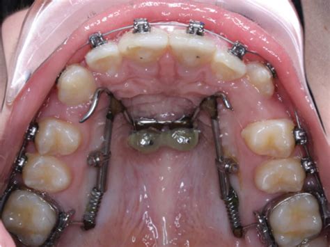 Maxillary Distalization With TADs Orthodontic Products 42 OFF