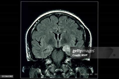 112 Epilepsy Mri Stock Photos, High-Res Pictures, and Images - Getty Images