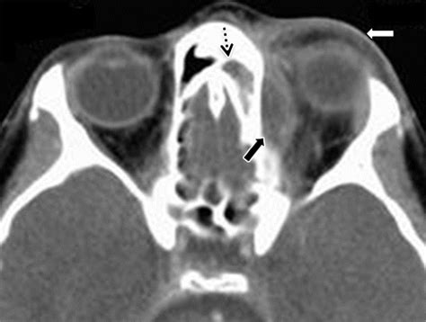 Orbital Septum Radiology