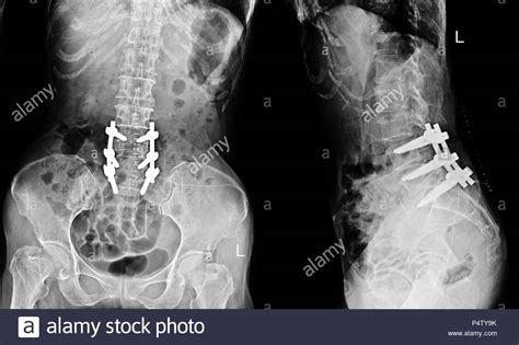 Lumbar Laminectomy Stock Photos Lumbar Laminectomy Stock Images Alamy