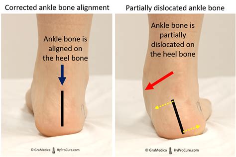 Heel Pain Pediatricsevers Diseasecalcaneal Apophysitis Gramedica