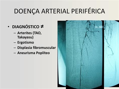 Ppt DoenÇa Arterial PerifÉrica Dap Parte I Powerpoint