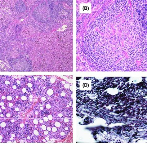 Histological Findings Of TAFRO Syndrome Lymph Nodes A B And Bone