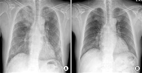 Chest X Ray Showing New Right Upper Lobe Consolidation With Download Scientific Diagram